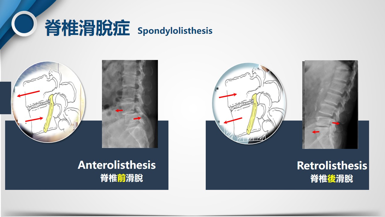 腰椎滑脫病因分類圖 2